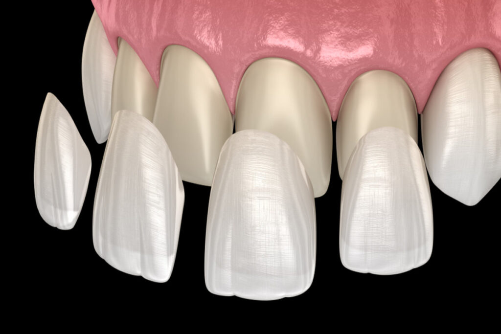 How Long Does The Veneer Procedure Take?