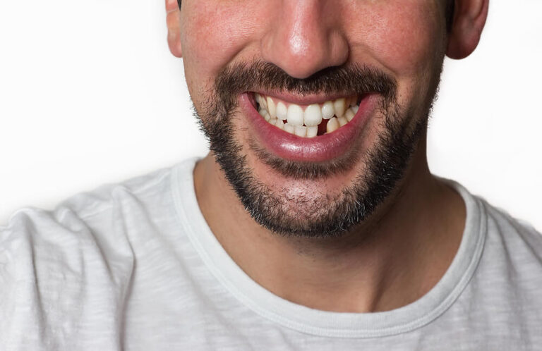 Missing Front Me What Are My Options for Replacing Missing Front Teeth?