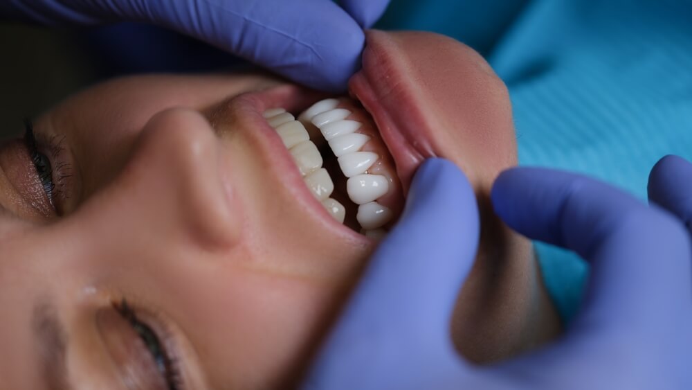 dental veneers cost