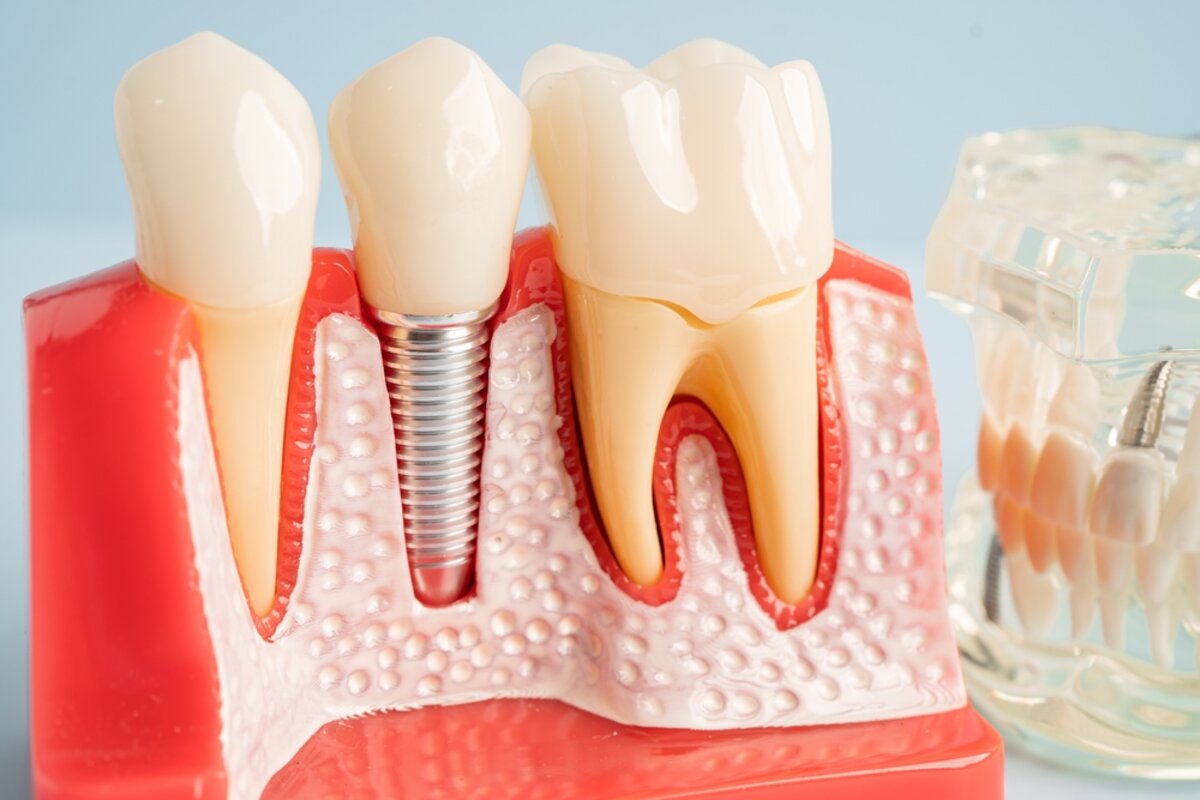 dental implants