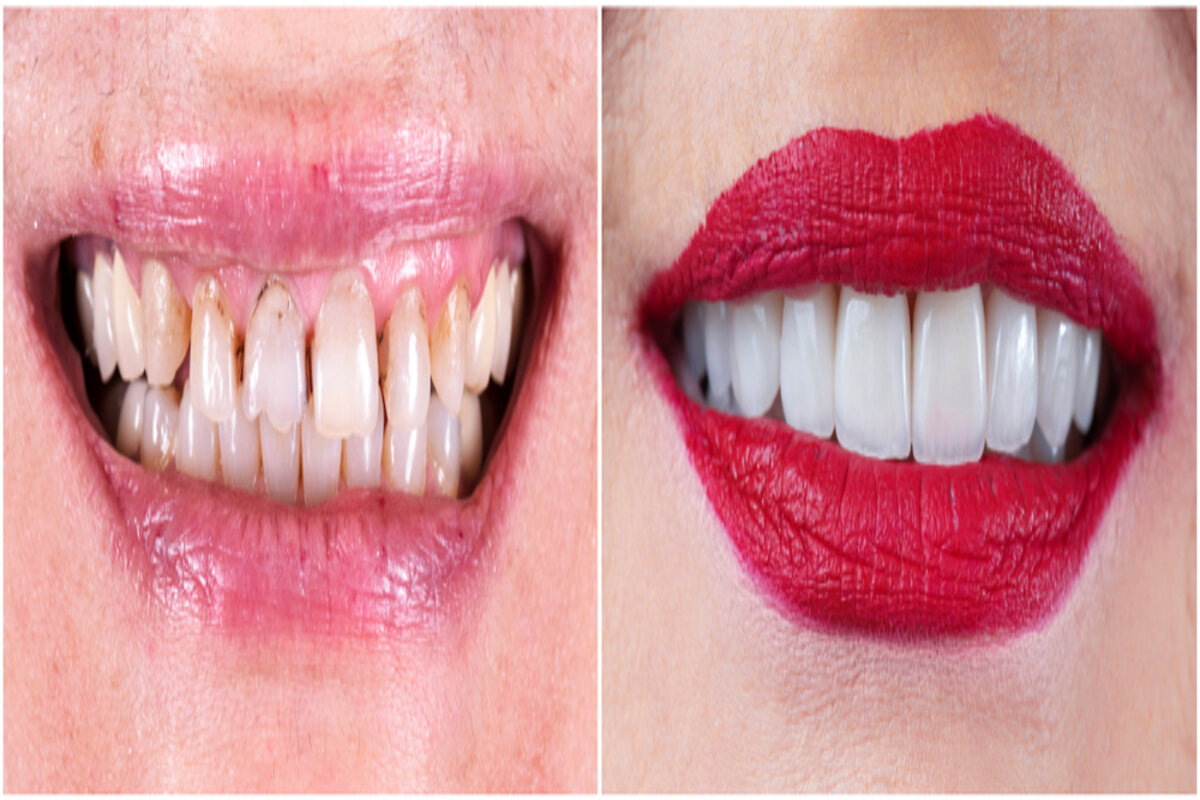 veneers or braces