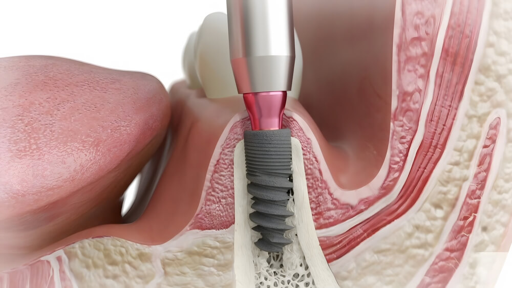 dental implant healing stages