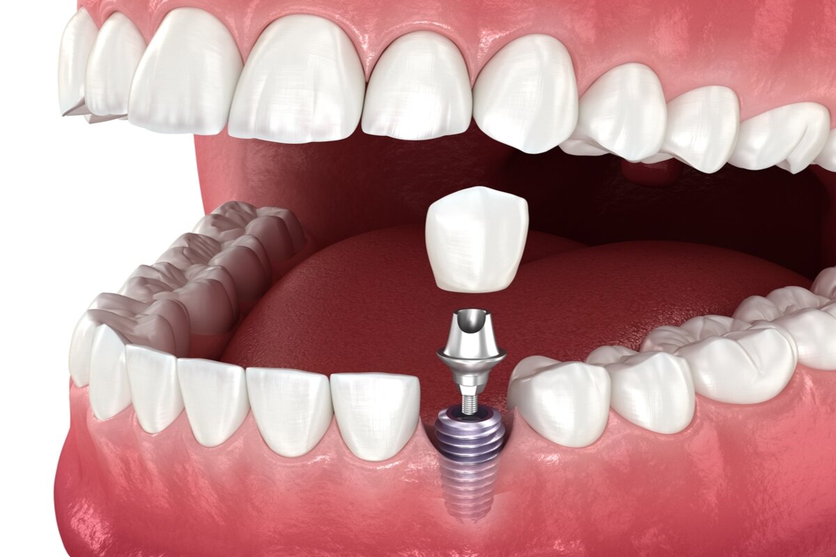 dental implant healing stages