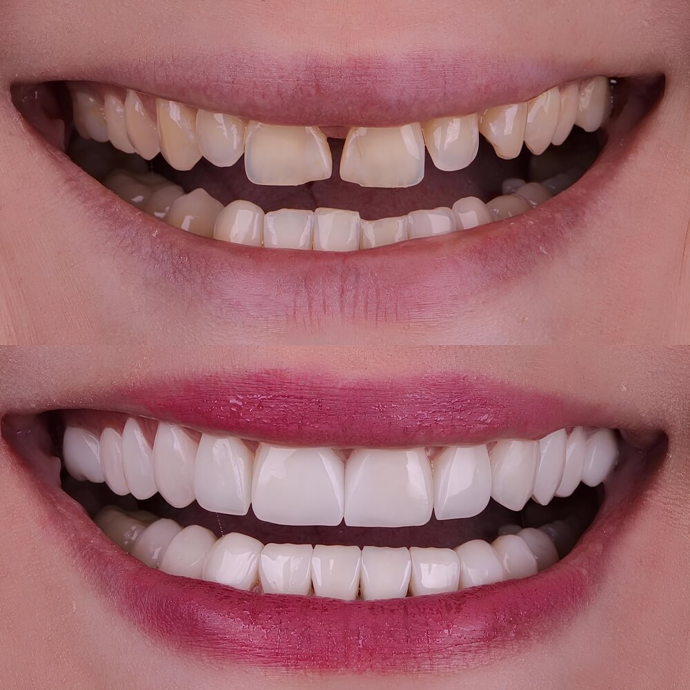 veneers fix crooked teeth