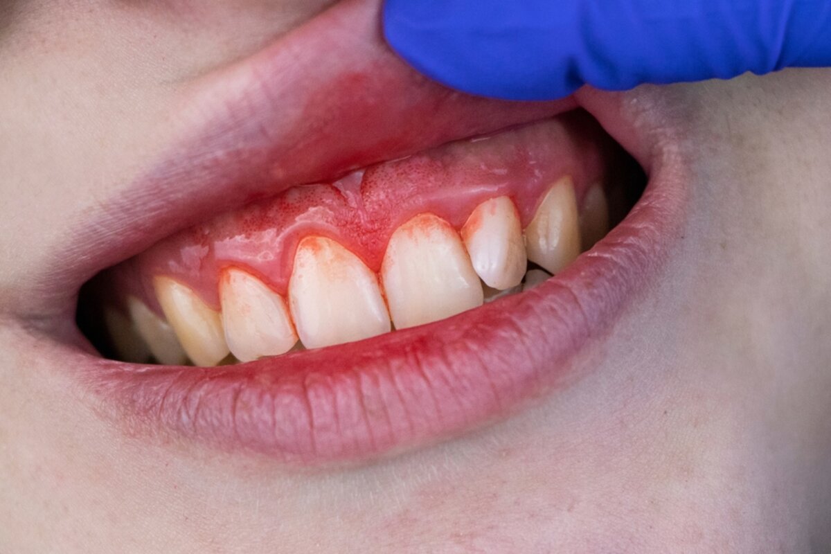 periodontitis