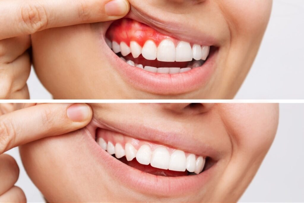 signs of gum disease