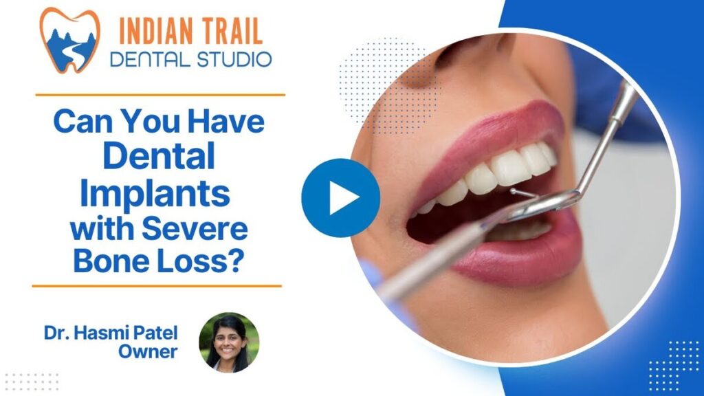 Can You Have Dental Implants with Severe Bone Loss?