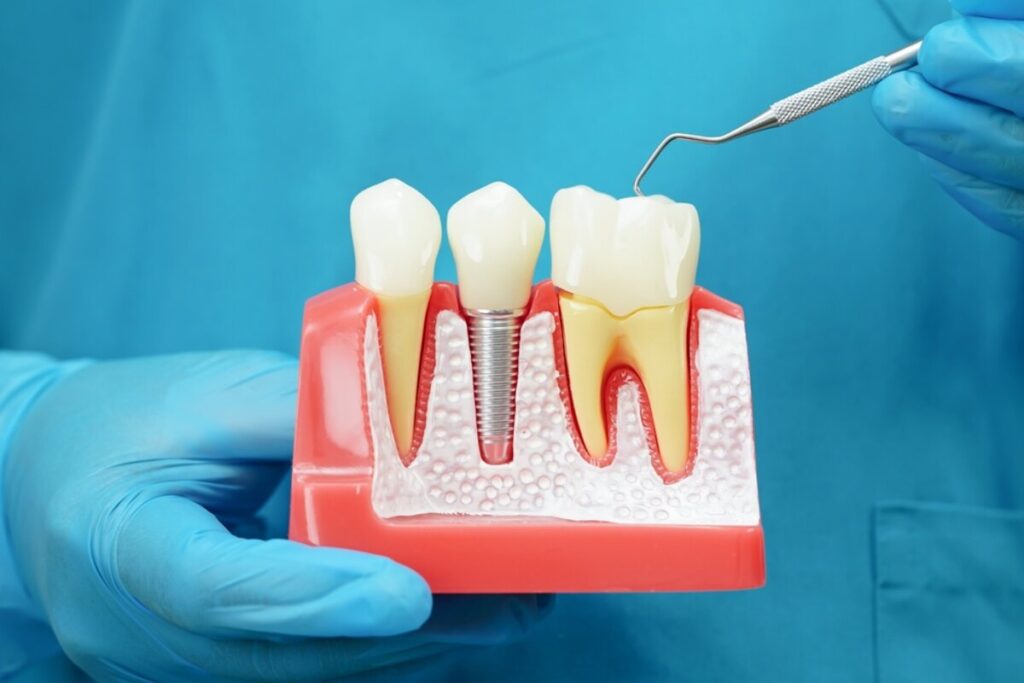 Can You Have Dental Implants with Severe Bone Loss? 