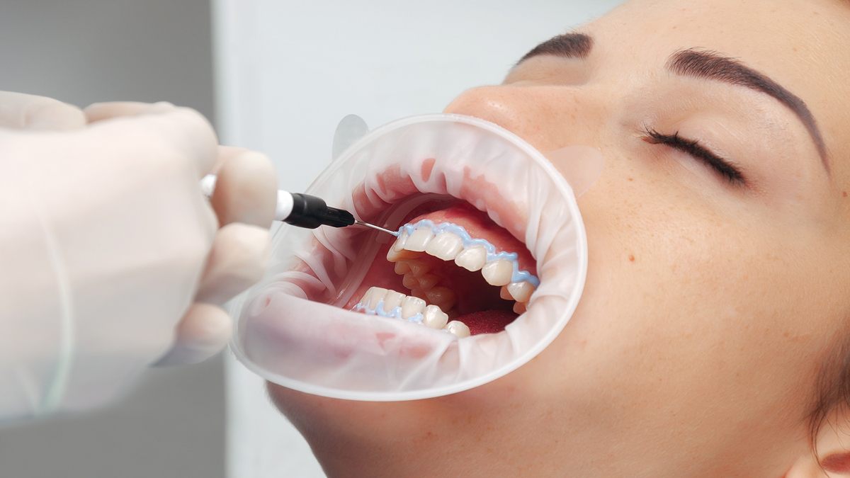How to Treat Burned Gums from Teeth Whitening