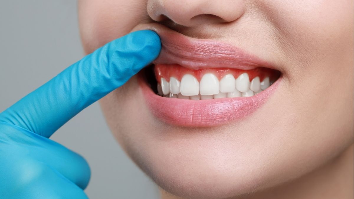 Can Receding Gums Be Reversed