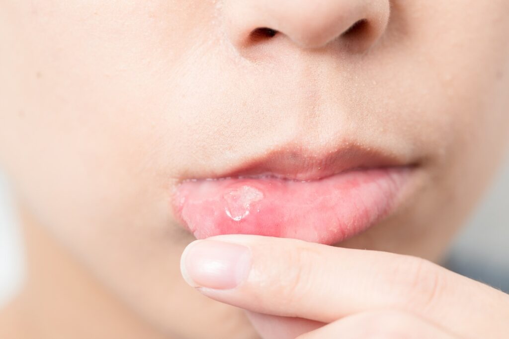 Canker Sores in Children: Causes, Symptoms, and Fast Relief Options