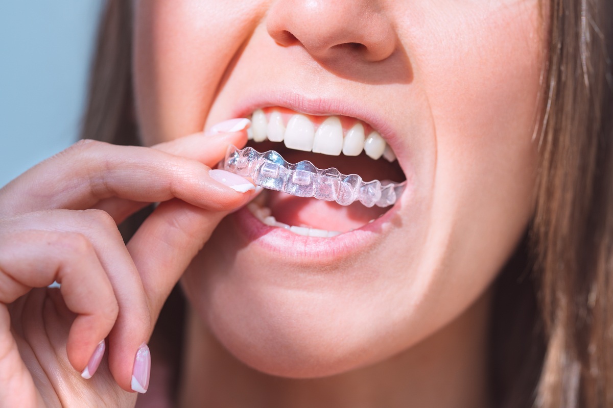 What To Ask Your Invisalign Dentist Before Starting Clear Aligners