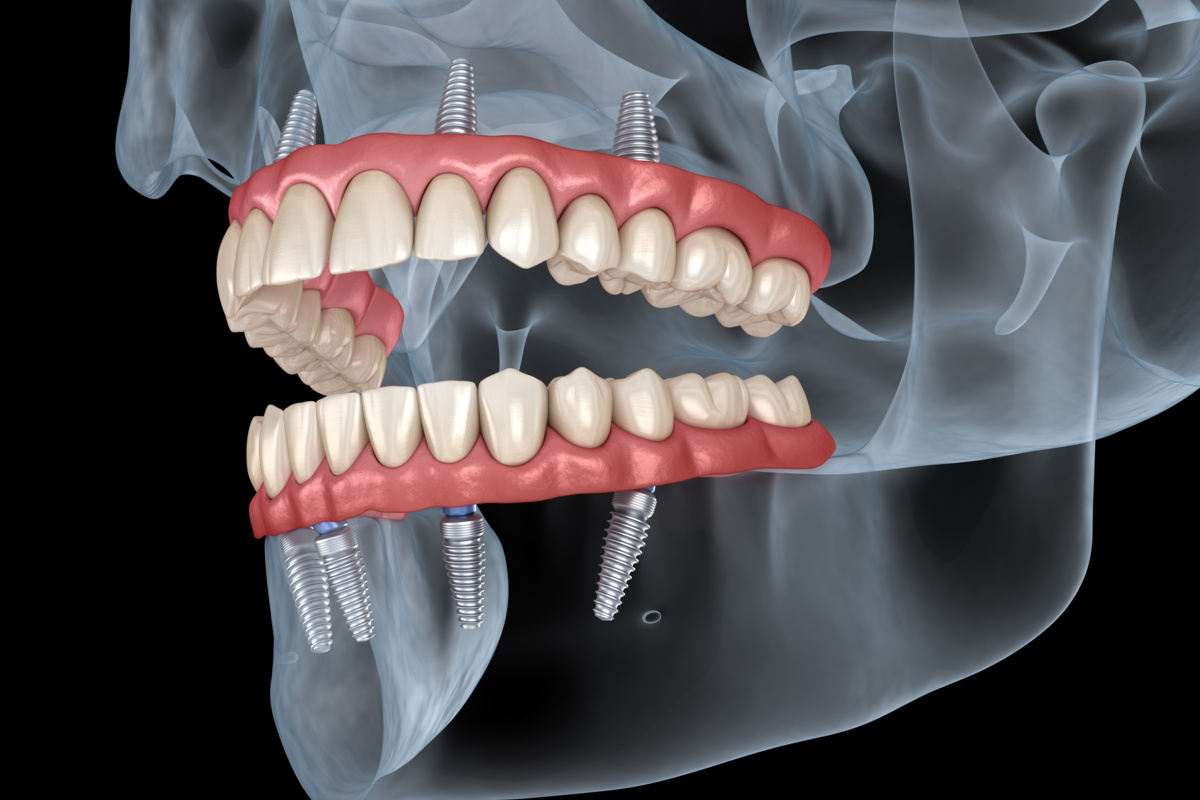 All-on-4 Dental Implants vs. Traditional: Which Is Better?