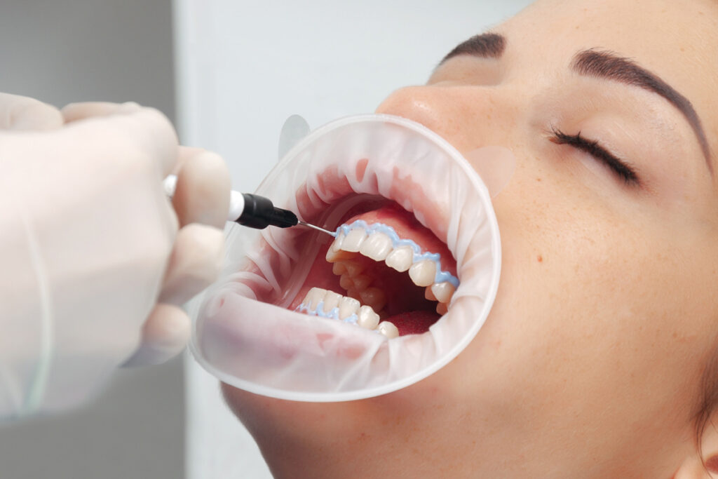 DIY Teeth Whitening: What Works and What Can Damage Your Teeth