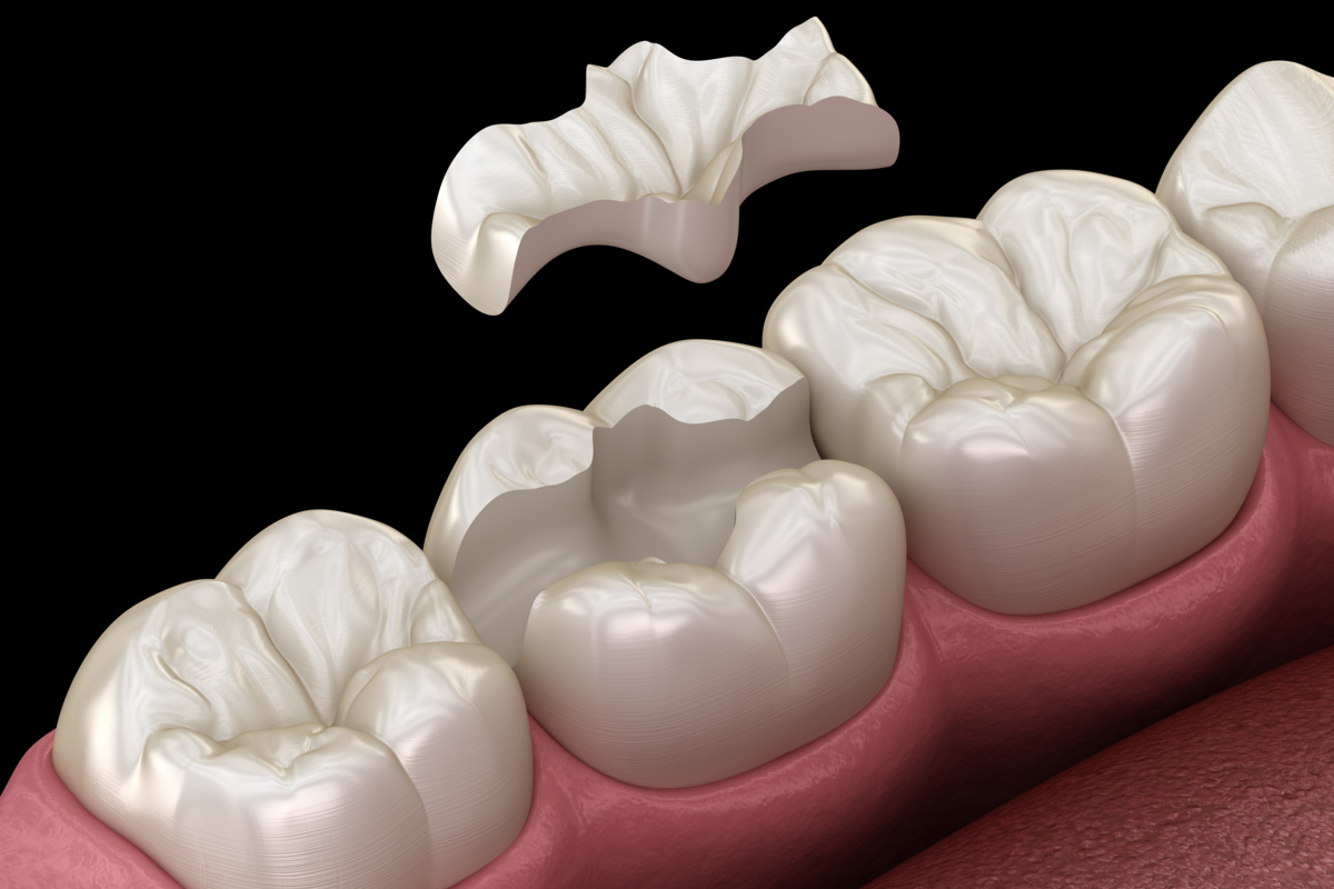 Dental Inlays or Onlays vs. Crowns: What’s Right for Your Tooth?