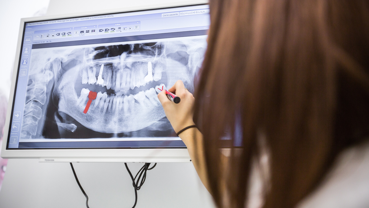 How to Know If You’re a Candidate for All-on-4 Dental Implants