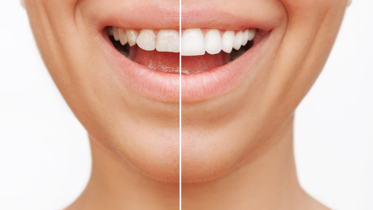 How to Maintain Your Veneers So They Last 15+ Years
