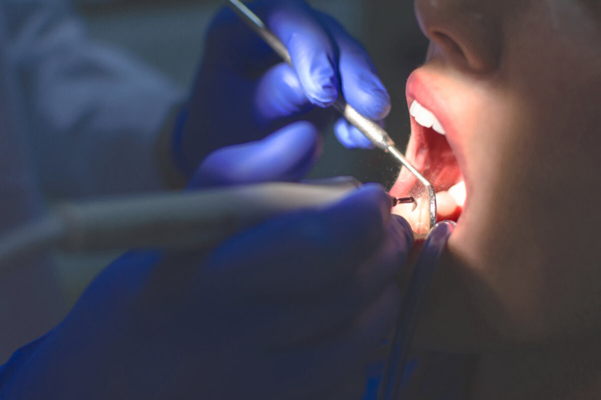 Close-up of air polishing treatment during a Guided Biofilm Therapy cleaning