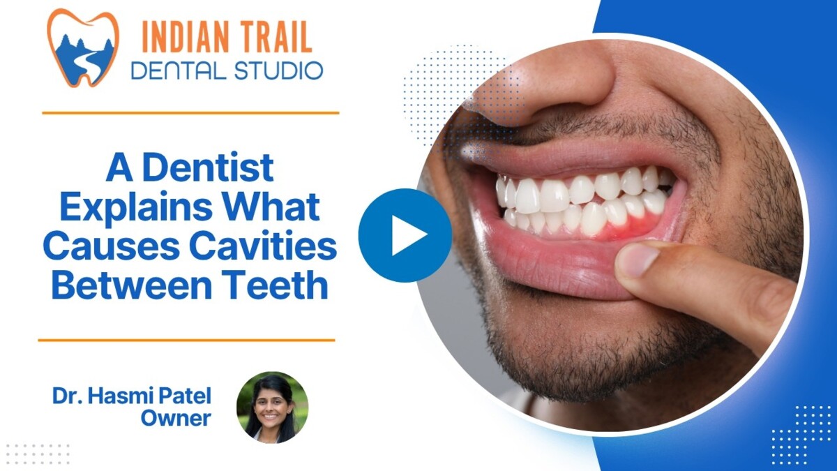 A Dentist Explains What Causes Cavities Between Teeth